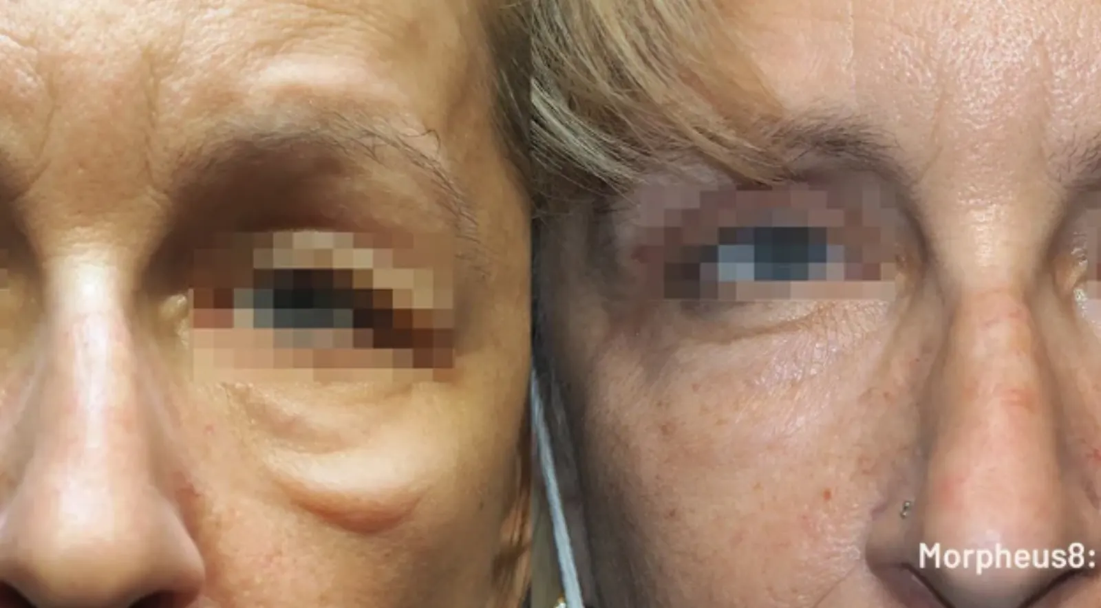 morpheus8 before after decatur