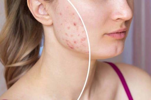 Acne Scar Removal