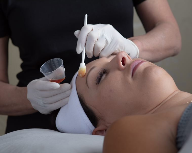 Chemical Peels