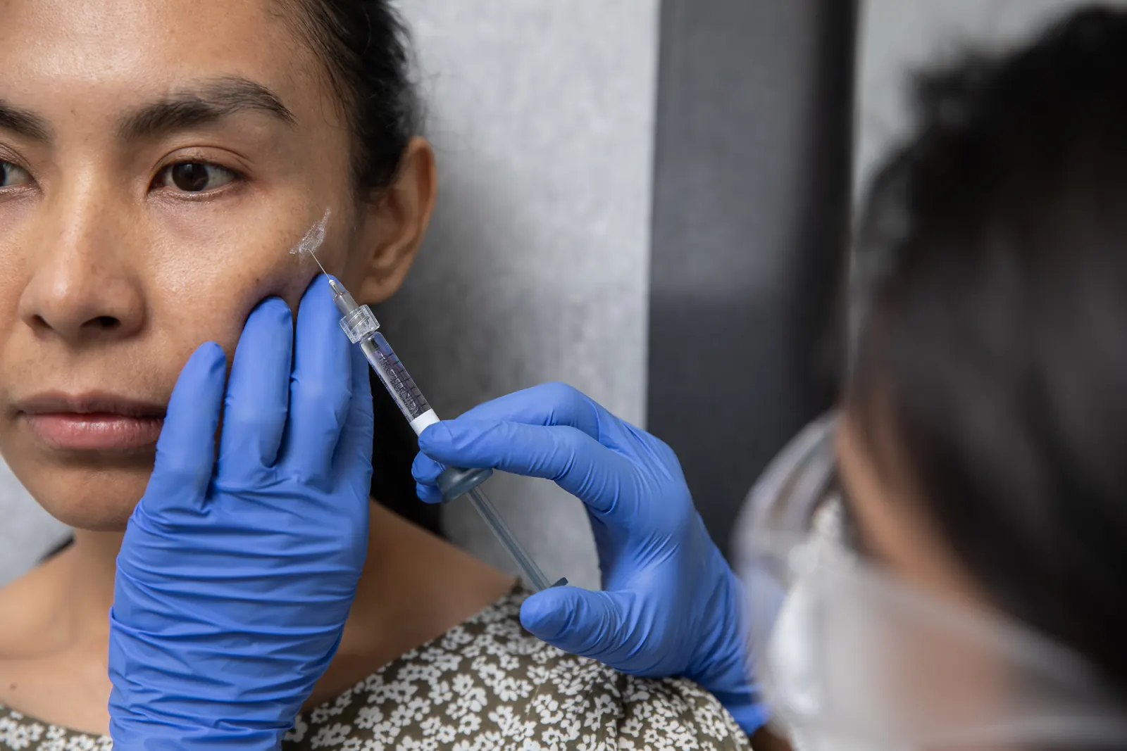 Dermal filler results showing youthful skin