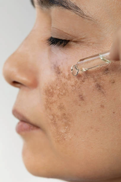Dermatologist examining skin for hyperpigmentation treatment