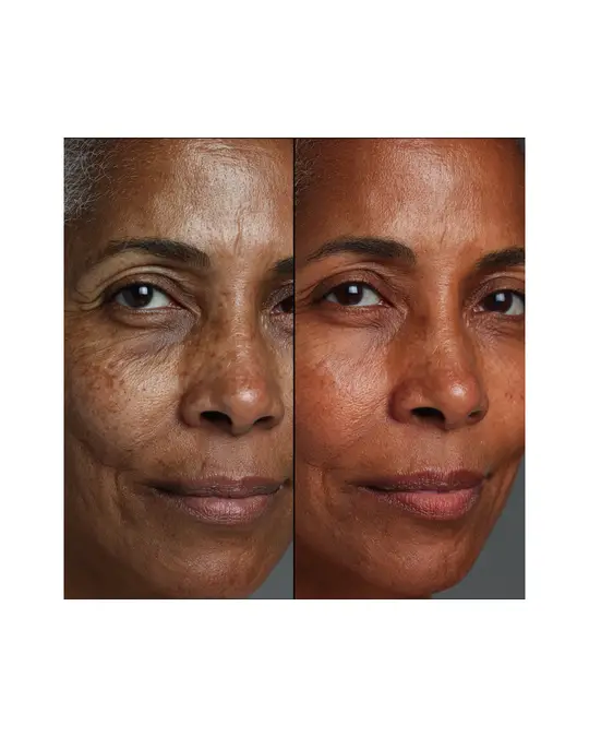 Morpheus8 Before & After 7