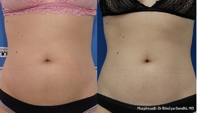 Morpheus8 Before & After - Abdominal Tightening