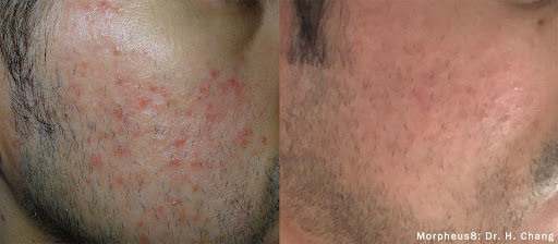 Morpheus8 Before & After - Acne Scar Treatment
