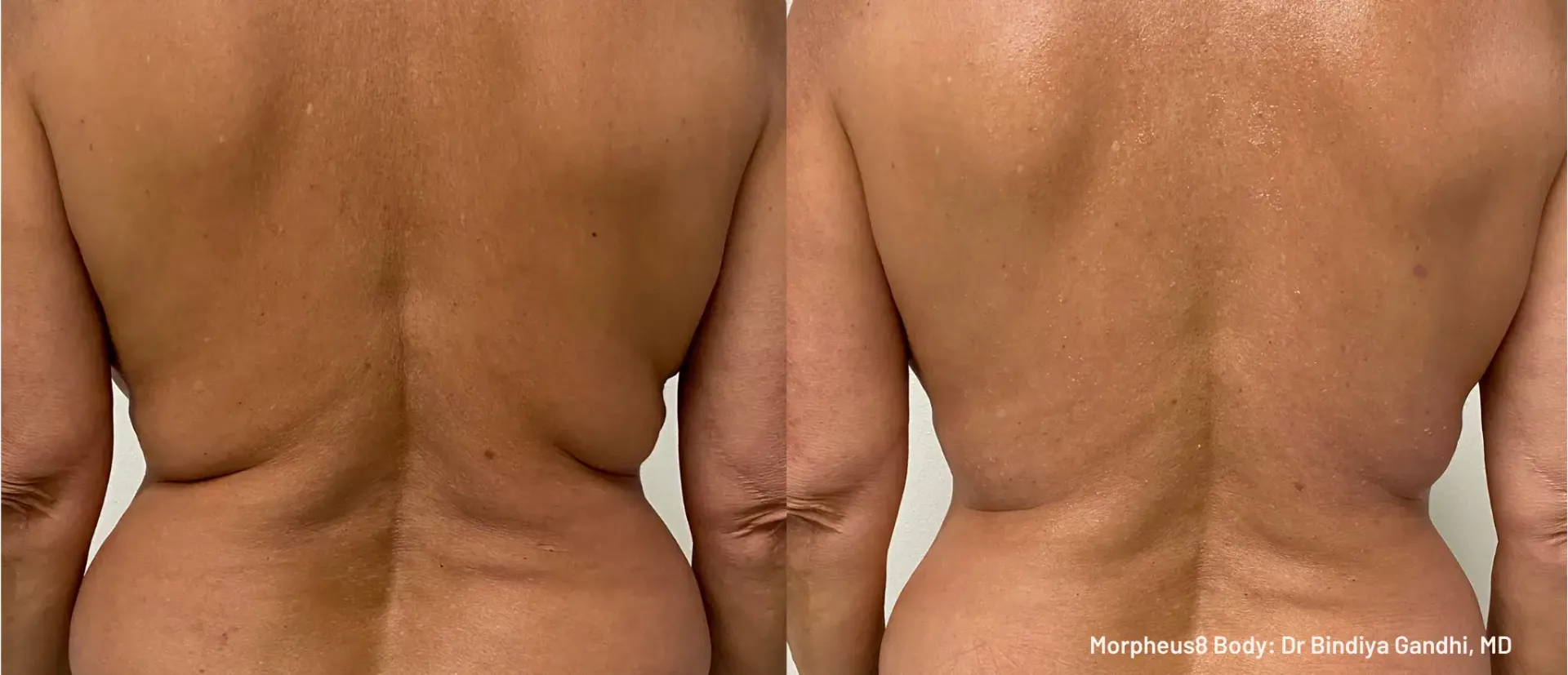 Morpheus8 Before & After - Back Skin Tightening