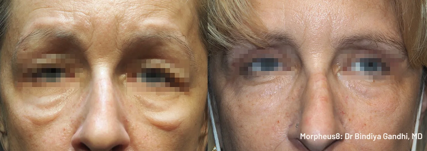 Morpheus8 Before & After - Facial Wrinkle Reduction