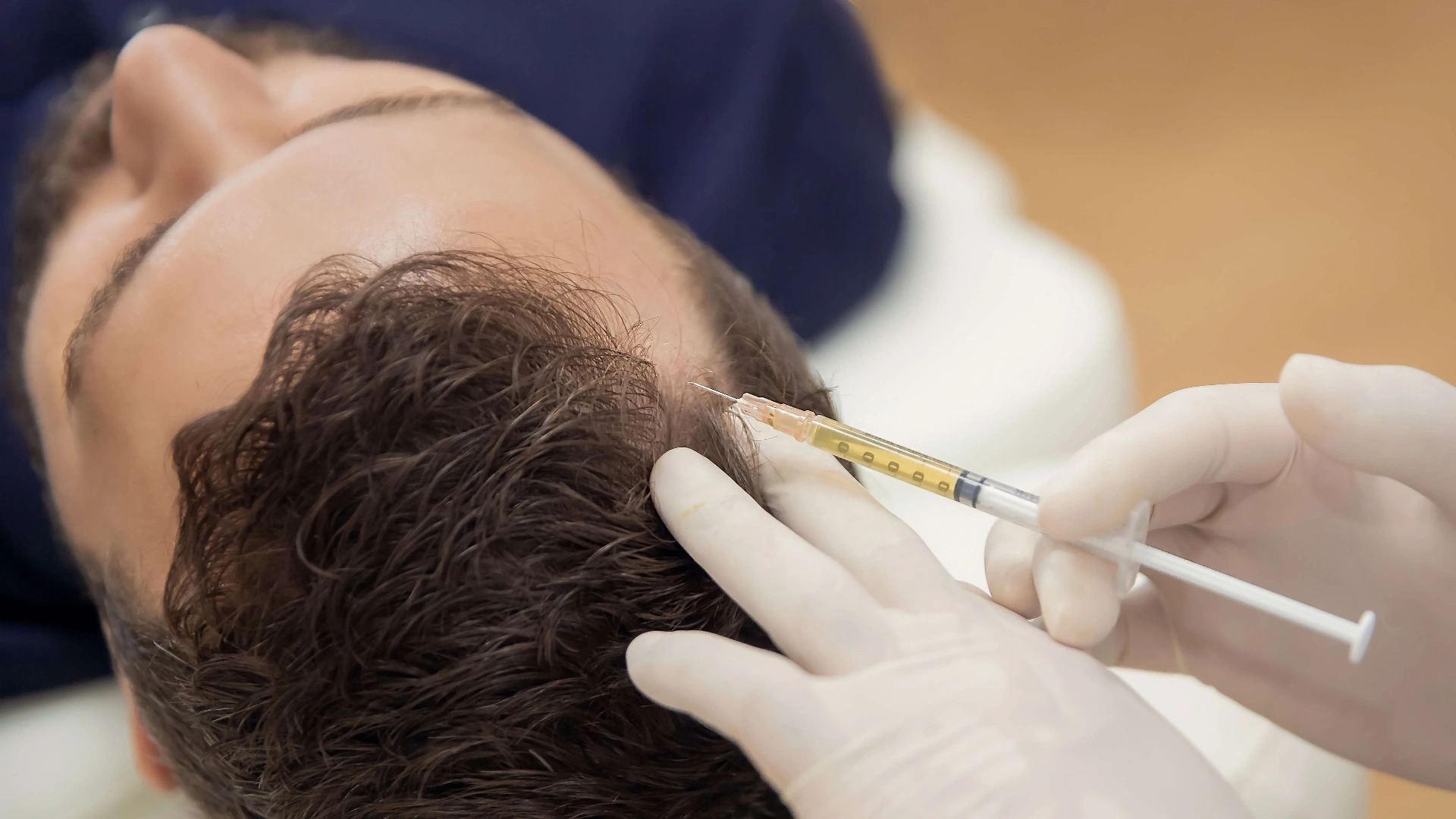 PRP alternative hair restoration exosome therapy treatment